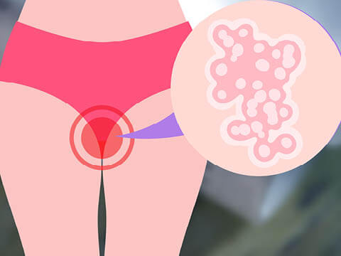 Herpes Genitale- Approfondimenti, Sintomi e Cura -480x360px